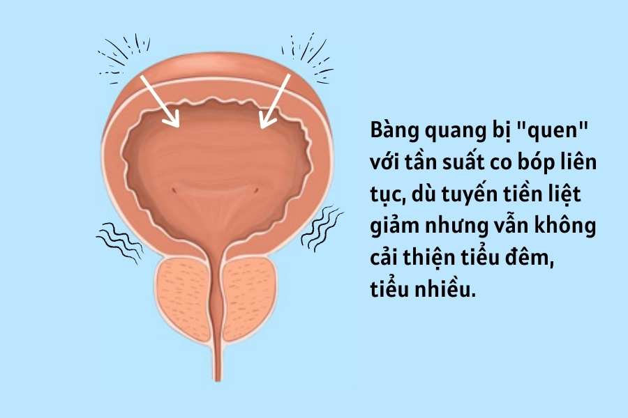 Phẫu thuật tuyến tiền liệt xong vẫn đi tiểu đêm 5-6 lần, phải làm sao?